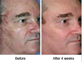Before and after photo of mans face after treatment Complete Healthcare Primary Care and Gynecology