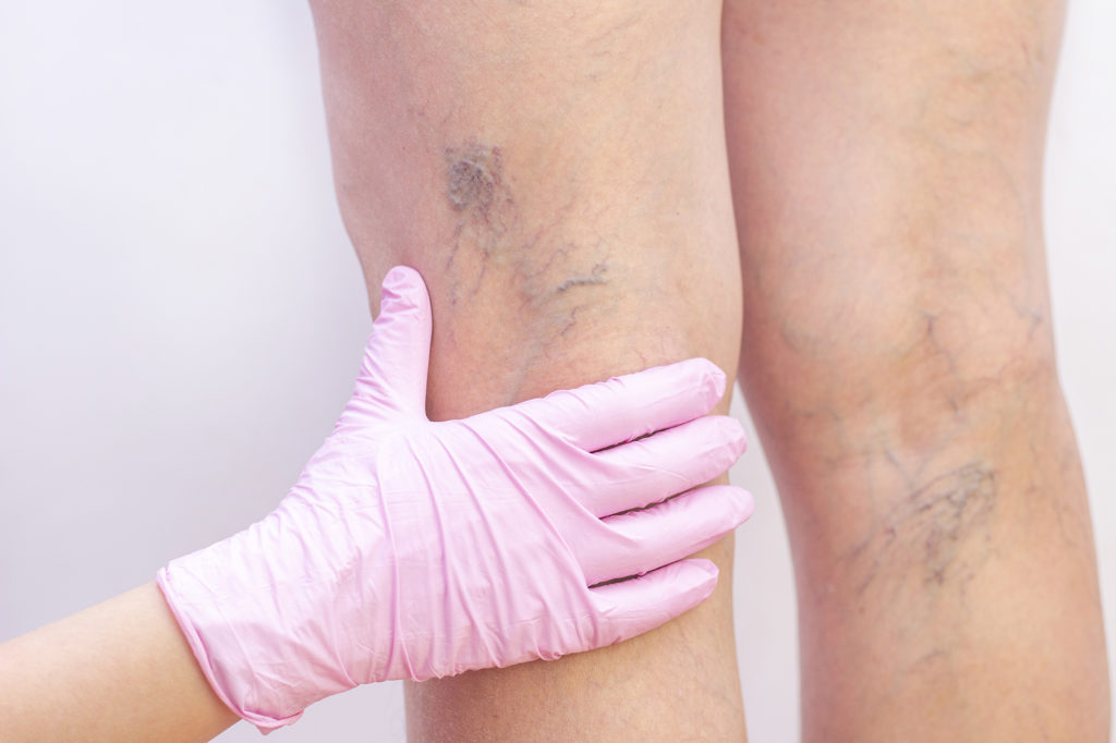 Nurse inspecting varicose veins on back of womans legs Complete Healthcare Primary Care and Gynecology