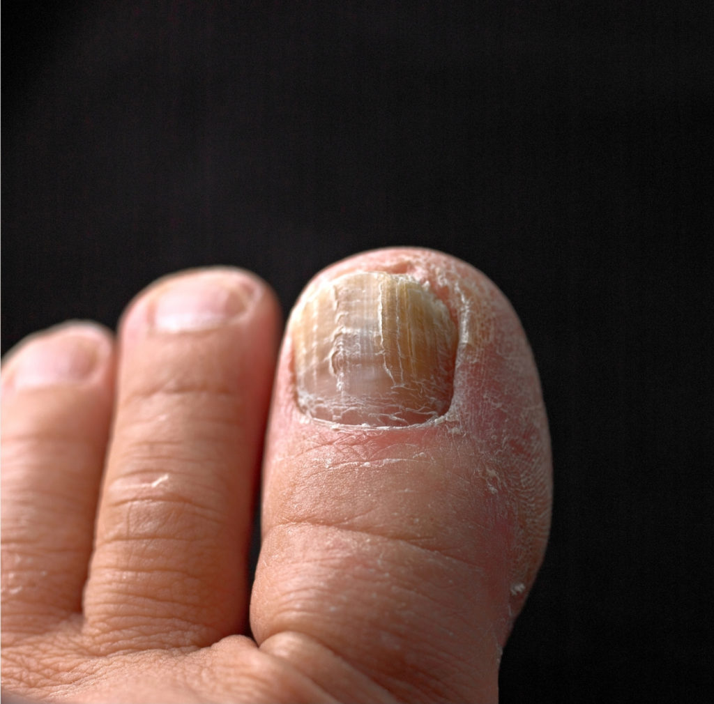 Closeup of fungus toenails on black background Complete Healthcare Primary Care and Gynecology