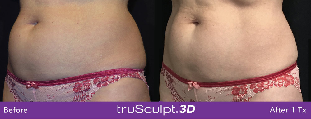 Before and after photo of womans stomach trusculpt Complete Healthcare Primary Care and Gynecology